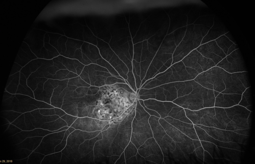 osteoma (10)
