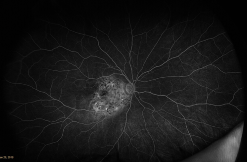 osteoma (11)
