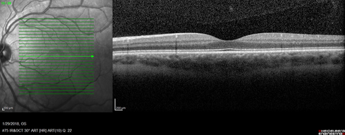 osteoma (4)
