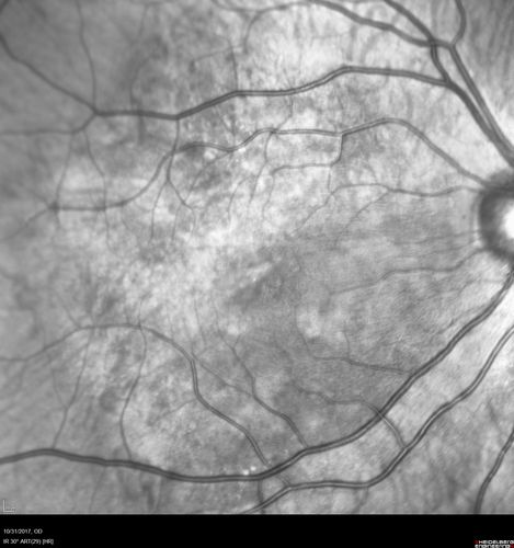 Choroidal Osteoma 13 Year Old
13 year old with 6 months of vision loss right eye and vision of 20/40
