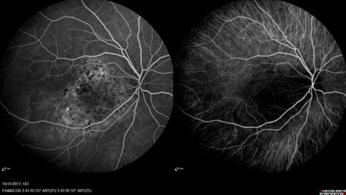 Choroidal Osteoma 13 Year Old
13 year old with 6 months of vision loss right eye and vision of 20/40
