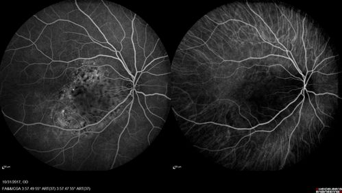 Choroidal Osteoma 13 Year Old
13 year old with 6 months of vision loss right eye and vision of 20/40
