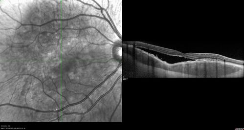 Choroidal Osteoma 13 Year Old
13 year old with 6 months of vision loss right eye and vision of 20/40
