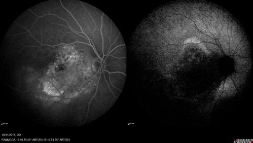 Choroidal Osteoma 13 Year Old
13 year old with 6 months of vision loss right eye and vision of 20/40
