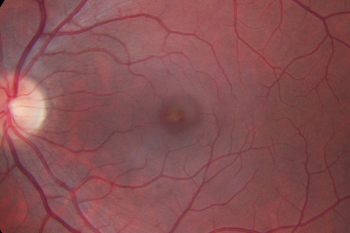 Outer Retinal Holes - Probably Solar Retinopathy (history is negative)
