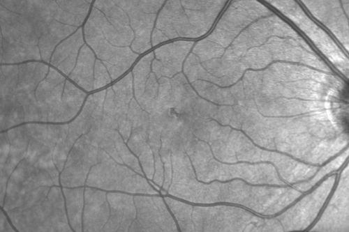 Outer Retinal Holes - Probably Solar Retinopathy (history is negative)
