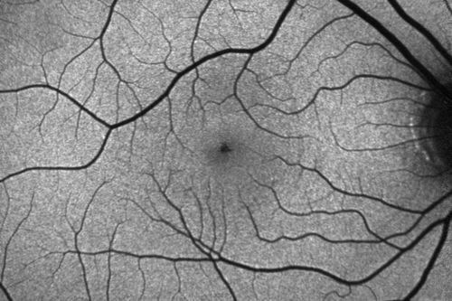 Outer Retinal Holes - Probably Solar Retinopathy (history is negative)
