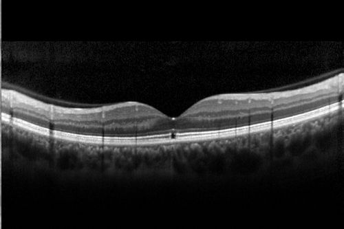 Outer Retinal Holes - Probably Solar Retinopathy (history is negative)
