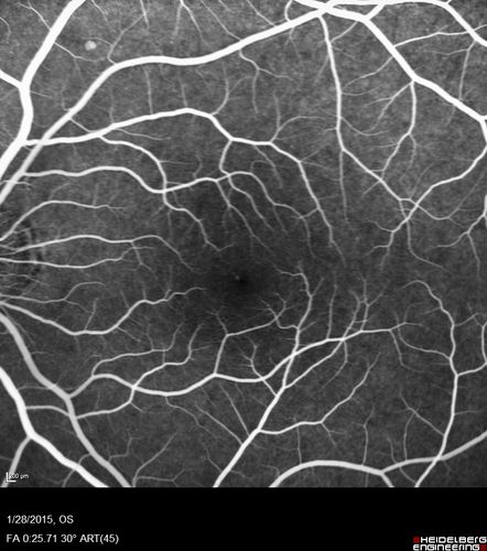 Outer Retinal Holes - Probably Solar Retinopathy (history is negative)
