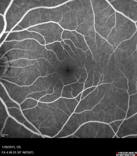 Outer Retinal Holes - Probably Solar Retinopathy (history is negative)
