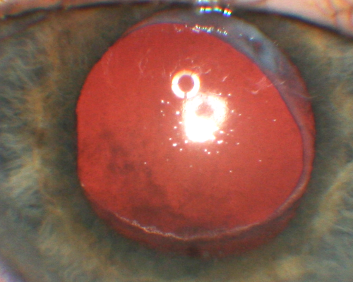 Propionibacterium acnes endophthalmitis with capsular plaque and uveitis
61 year old man with inflammation after cataract surgery who ultimately needed removal of intraocular lens and capsule to quiet eye.

