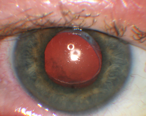Propionibacterium acnes endophthalmitis with capsular plaque and uveitis
61 year old man with inflammation after cataract surgery who ultimately needed removal of intraocular lens and capsule to quiet eye.

