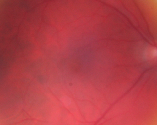 Propionibacterium acnes endophthalmitis with capsular plaque and uveitis
61 year old man with inflammation after cataract surgery who ultimately needed removal of intraocular lens and capsule to quiet eye.
