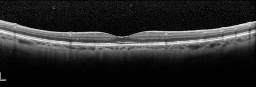 Cardiac Catheterization induced Cilioretinal Artery Occlusion - Paracentral Acute Middle Maculopathy
69 year old female with sudden vision loss on completing cardiac catheterization.  The SD OCT shows a PAMM lesion and the lesion looks gray on color imaging.  There is delayed filling of the cilioretinal artery.
