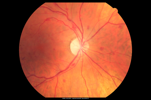 CRVO with Paracentral Acute Middle Maculopath - PAMM
56 year old woman with sudden vision loss, hemorrhages in all four quadrants.  FA shows good retinal circulation.  The OCT shows PAMM lesions in the affected eye.  Vision did improve on second visit from 20/160 to 20/60 in about a month
