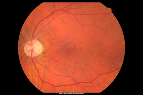 CRVO with Paracentral Acute Middle Maculopath - PAMM
56 year old woman with sudden vision loss, hemorrhages in all four quadrants.  FA shows good retinal circulation.  The OCT shows PAMM lesions in the affected eye.  Vision did improve on second visit from 20/160 to 20/60 in about a month

