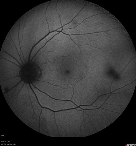 CRVO with Paracentral Acute Middle Maculopath - PAMM
56 year old woman with sudden vision loss, hemorrhages in all four quadrants.  FA shows good retinal circulation.  The OCT shows PAMM lesions in the affected eye.  Vision did improve on second visit from 20/160 to 20/60 in about a month

