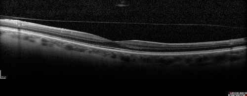 CRVO with Paracentral Acute Middle Maculopath - PAMM
56 year old woman with sudden vision loss, hemorrhages in all four quadrants.  FA shows good retinal circulation.  The OCT shows PAMM lesions in the affected eye.  Vision did improve on second visit from 20/160 to 20/60 in about a month
