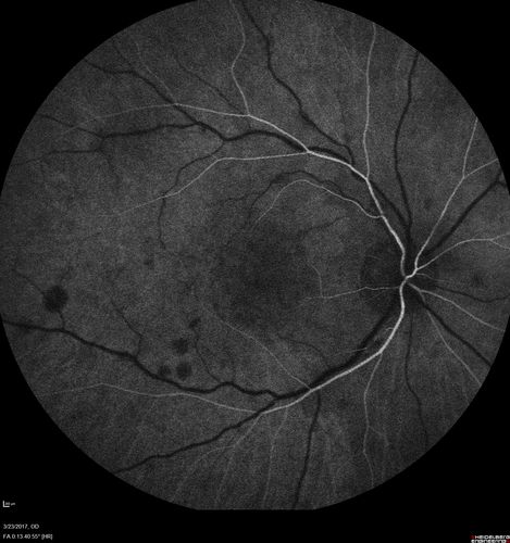 CRVO with Paracentral Acute Middle Maculopath - PAMM
56 year old woman with sudden vision loss, hemorrhages in all four quadrants.  FA shows good retinal circulation.  The OCT shows PAMM lesions in the affected eye.  Vision did improve on second visit from 20/160 to 20/60 in about a month
