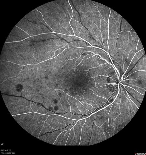 CRVO with Paracentral Acute Middle Maculopath - PAMM
56 year old woman with sudden vision loss, hemorrhages in all four quadrants.  FA shows good retinal circulation.  The OCT shows PAMM lesions in the affected eye.  Vision did improve on second visit from 20/160 to 20/60 in about a month
