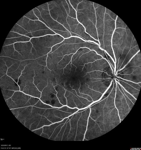 CRVO with Paracentral Acute Middle Maculopath - PAMM
56 year old woman with sudden vision loss, hemorrhages in all four quadrants.  FA shows good retinal circulation.  The OCT shows PAMM lesions in the affected eye.  Vision did improve on second visit from 20/160 to 20/60 in about a month
