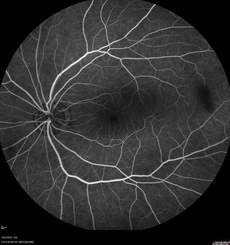 CRVO with Paracentral Acute Middle Maculopath - PAMM
56 year old woman with sudden vision loss, hemorrhages in all four quadrants.  FA shows good retinal circulation.  The OCT shows PAMM lesions in the affected eye.  Vision did improve on second visit from 20/160 to 20/60 in about a month
