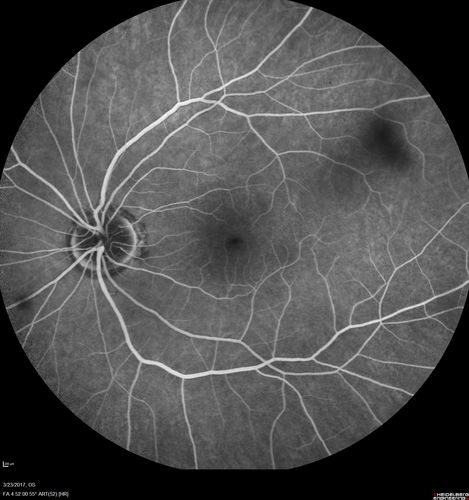CRVO with Paracentral Acute Middle Maculopath - PAMM
56 year old woman with sudden vision loss, hemorrhages in all four quadrants.  FA shows good retinal circulation.  The OCT shows PAMM lesions in the affected eye.  Vision did improve on second visit from 20/160 to 20/60 in about a month

