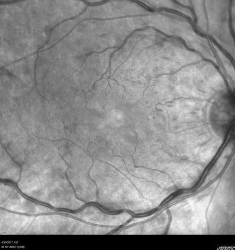 CRVO with Paracentral Acute Middle Maculopath - PAMM
56 year old woman with sudden vision loss, hemorrhages in all four quadrants.  FA shows good retinal circulation.  The OCT shows PAMM lesions in the affected eye.  Vision did improve on second visit from 20/160 to 20/60 in about a month
