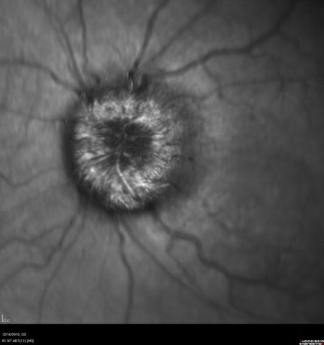 Papilledema Lateral Sinus Thrombosis
35 year old female Noticed blurred vision when waking up in the morning.  Also, vision blacks out for a few seconds when she gets up quickly. About 3 months ago she had a history of intermittent vomiting.

VA 20/20 OD, 20/25 OS

MRI normal,  MRA showed lateral sinus thrombosis.  Lupus anticoagulant was positive
