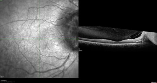 Papilledema Lateral Sinus Thrombosis
35 year old female Noticed blurred vision when waking up in the morning.  Also, vision blacks out for a few seconds when she gets up quickly. About 3 months ago she had a history of intermittent vomiting.

VA 20/20 OD, 20/25 OS

MRI normal,  MRA showed lateral sinus thrombosis.  Lupus anticoagulant was positive
