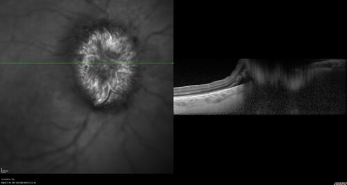 Papilledema Lateral Sinus Thrombosis
35 year old female Noticed blurred vision when waking up in the morning.  Also, vision blacks out for a few seconds when she gets up quickly. About 3 months ago she had a history of intermittent vomiting.

VA 20/20 OD, 20/25 OS

MRI normal,  MRA showed lateral sinus thrombosis.  Lupus anticoagulant was positive
