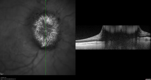Papilledema Lateral Sinus Thrombosis
35 year old female Noticed blurred vision when waking up in the morning.  Also, vision blacks out for a few seconds when she gets up quickly. About 3 months ago she had a history of intermittent vomiting.

VA 20/20 OD, 20/25 OS

MRI normal,  MRA showed lateral sinus thrombosis.  Lupus anticoagulant was positive
