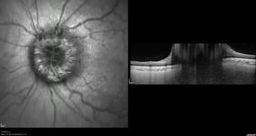 Papilledema Lateral Sinus Thrombosis
35 year old female Noticed blurred vision when waking up in the morning.  Also, vision blacks out for a few seconds when she gets up quickly. About 3 months ago she had a history of intermittent vomiting.

VA 20/20 OD, 20/25 OS

MRI normal,  MRA showed lateral sinus thrombosis.  Lupus anticoagulant was positive
