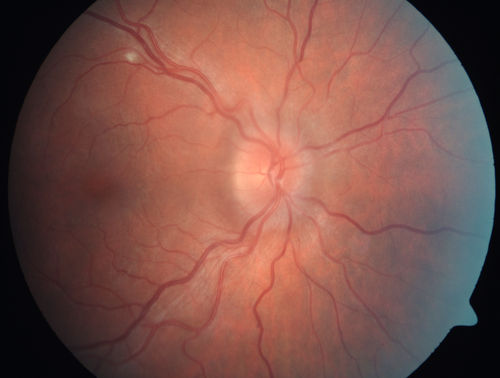 Papilledema - Sagittal Cerebral Vein Thrombosis - Lung Transplant Cystic Fibrosis 36 Year Old Man
Color Photo

