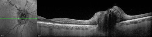 Papilledema - Sagittal Cerebral Vein Thrombosis - Lung Transplant Cystic Fibrosis 36 Year Old Man
Line scan through optic nerve
