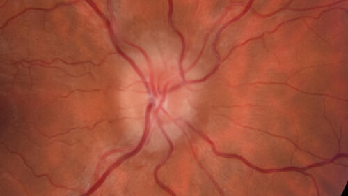 Idiopathic Intracranial Hypertension - Papilledema
37 year old obese female Was on for an eye examination and a problem was noted.  Her vision is normal.  She has mild headaches which are from TMJ.
PMhx: Polycystic Ovary Syndrome (not diabetic)
Meds: Metformin, Vitamin D, Spironolactone
VA 20/12 OD, 20/16 OS
Opening ICP on spinal tap was 30 CM water.
