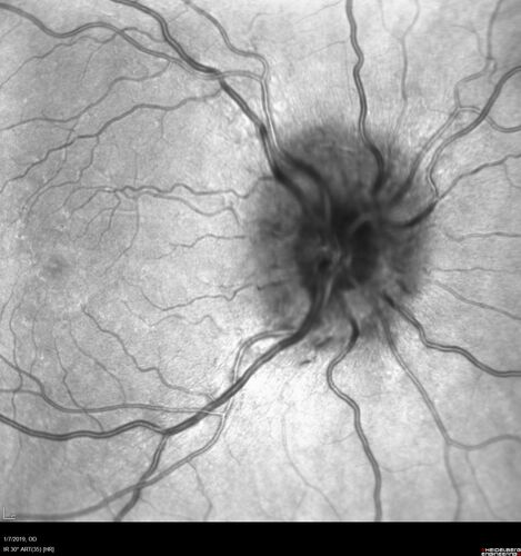 Idiopathic Intracranial Hypertension - Papilledema
37 year old obese female Was on for an eye examination and a problem was noted.  Her vision is normal.  She has mild headaches which are from TMJ.
PMhx: Polycystic Ovary Syndrome (not diabetic)
Meds: Metformin, Vitamin D, Spironolactone
VA 20/12 OD, 20/16 OS
Opening ICP on spinal tap was 30 CM water.
