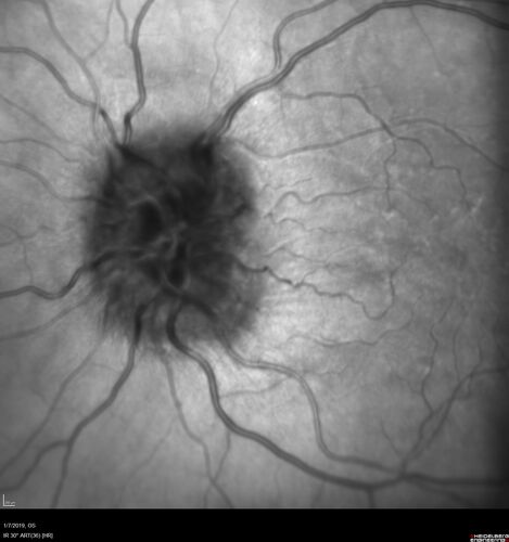 Idiopathic Intracranial Hypertension - Papilledema
37 year old obese female Was on for an eye examination and a problem was noted.  Her vision is normal.  She has mild headaches which are from TMJ.
PMhx: Polycystic Ovary Syndrome (not diabetic)
Meds: Metformin, Vitamin D, Spironolactone
VA 20/12 OD, 20/16 OS
Opening ICP on spinal tap was 30 CM water.
