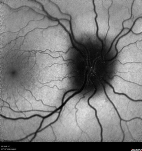 Idiopathic Intracranial Hypertension - Papilledema
37 year old obese female Was on for an eye examination and a problem was noted.  Her vision is normal.  She has mild headaches which are from TMJ.
PMhx: Polycystic Ovary Syndrome (not diabetic)
Meds: Metformin, Vitamin D, Spironolactone
VA 20/12 OD, 20/16 OS
Opening ICP on spinal tap was 30 CM water.
