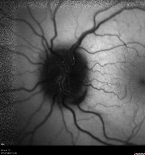 Idiopathic Intracranial Hypertension - Papilledema
37 year old obese female Was on for an eye examination and a problem was noted.  Her vision is normal.  She has mild headaches which are from TMJ.
PMhx: Polycystic Ovary Syndrome (not diabetic)
Meds: Metformin, Vitamin D, Spironolactone
VA 20/12 OD, 20/16 OS
Opening ICP on spinal tap was 30 CM water.
