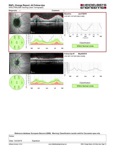 Idiopathic Intracranial Hypertension - Papilledema
37 year old obese female Was on for an eye examination and a problem was noted.  Her vision is normal.  She has mild headaches which are from TMJ.
PMhx: Polycystic Ovary Syndrome (not diabetic)
Meds: Metformin, Vitamin D, Spironolactone
VA 20/12 OD, 20/16 OS
Opening ICP on spinal tap was 30 CM water.
