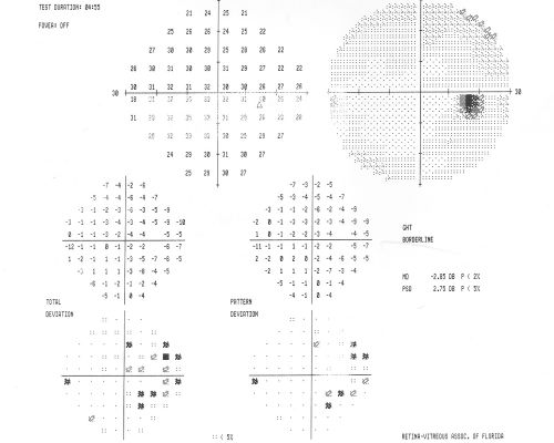 Papilledema post-spinal tap va 20/25
24-year-old woman was seen in the office on 2/23/2010.  She has had noticed positional blurring of her vision when she bends over since around November.  When she bends over and stands up straight, she notices her vision is blurred.   Vision OD is 20/100, PH 20/40; OS is 20/80, PH 20/30.  IOP:  19 OU.  
vision was 20/25 after tap
