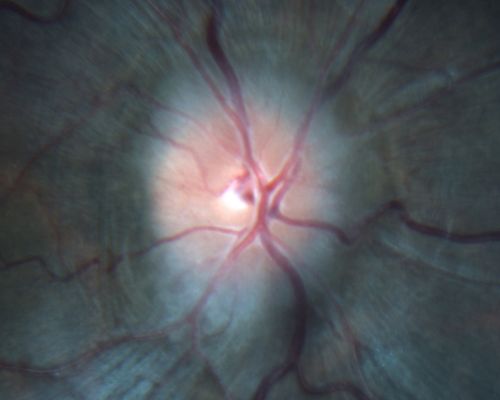 Papilledema post-spinal tap va 20/25
24-year-old woman was seen in the office on 2/23/2010.  She has had noticed positional blurring of her vision when she bends over since around November.  When she bends over and stands up straight, she notices her vision is blurred.   Vision OD is 20/100, PH 20/40; OS is 20/80, PH 20/30.  IOP:  19 OU.  
vision was 20/25 after tap
