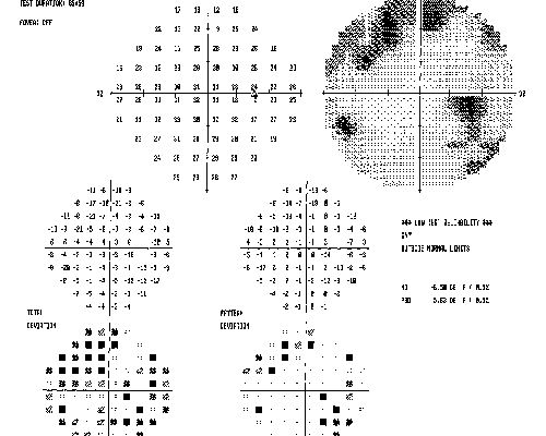 Papilledema from pseudotumor cerebri Pre Spinal Tap - VA 20/100
24-year-old woman was seen in the office on 2/23/2010.  She has had noticed positional blurring of her vision when she bends over since around November.  When she bends over and stands up straight, she notices her vision is blurred.   Vision OD is 20/100, PH 20/40; OS is 20/80, PH 20/30.  IOP:  19 OU.  
vision was 20/25 after tap
