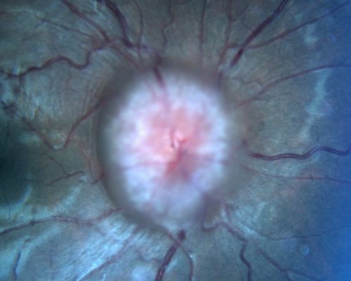 Papilledema from pseudotumor cerebri Pre Spinal Tap - VA 20/100
24-year-old woman was seen in the office on 2/23/2010.  She has had noticed positional blurring of her vision when she bends over since around November.  When she bends over and stands up straight, she notices her vision is blurred.   Vision OD is 20/100, PH 20/40; OS is 20/80, PH 20/30.  IOP:  19 OU.  
vision was 20/25 after tap
