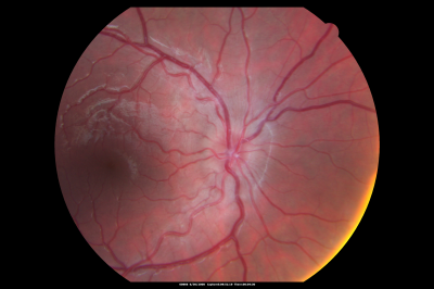 Papilledema 10 year old child
10-year-old child has uveitis in both eyes.  She probably has tubulointerstitial nephritis-uveitis syndrome, and she apparently also independently has idiopathic elevated intracranial pressure.  VISUAL ACUITY: Vision OU is 20/20.  
Keywords: papilledema; child;