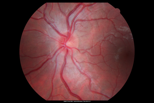Papilledema 10 year old child
10-year-old child has uveitis in both eyes.  She probably has tubulointerstitial nephritis-uveitis syndrome, and she apparently also independently has idiopathic elevated intracranial pressure.  VISUAL ACUITY: Vision OU is 20/20. 
Keywords: papilledema; child;