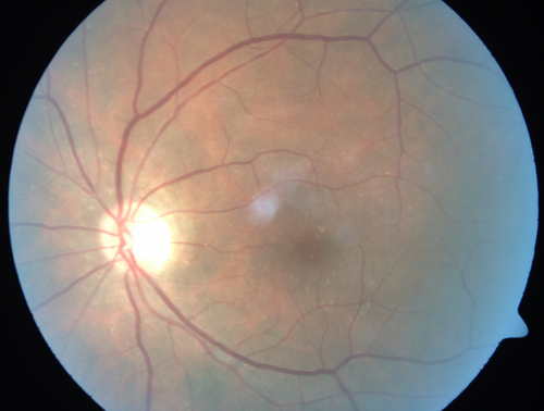 Adult Vitelliform Macular Dystrophy - Pattern Dystrophy

