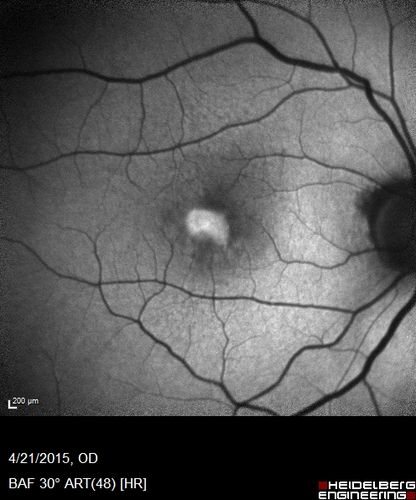 Adult Vitelliform Macular Dystrophy - Pattern Dystrophy
Bright subfoveal FAF from lipofuscin
