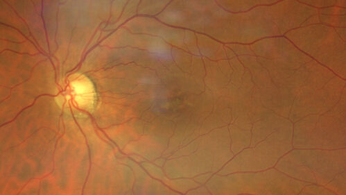 Pattern Dystrophy - PHPR2 Gene
57 year old man- VA 20/25 OD, 20/20 OS - Many family members have retinitis pigmentosa

